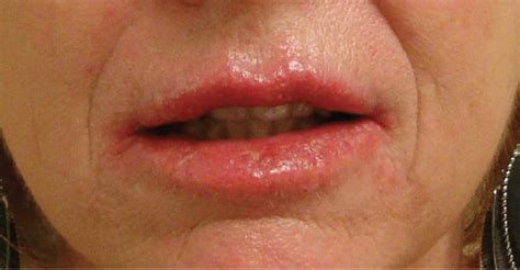 Tinea Infection of the Lips | Consultant360