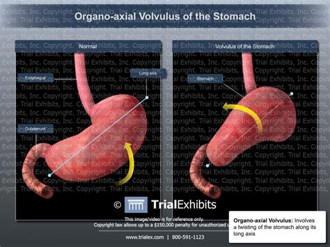 Organo-axial Volvulus of the Stomach - TrialQuest Inc.