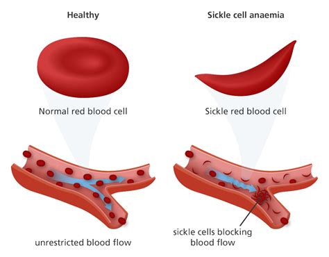 Anemia, sickle cell; Hemoglobin S Disease