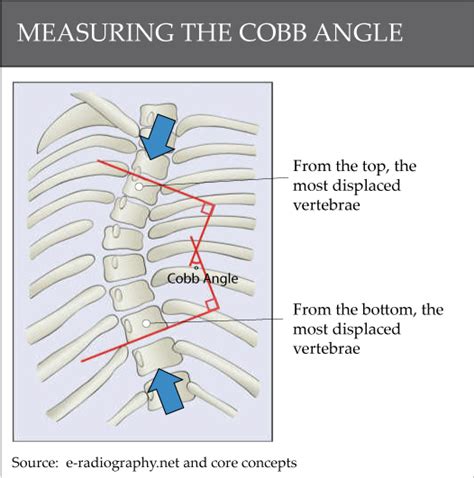 CARA MENGUKUR DERAJAT SCOLIOSIS - MEDIA FISIOTERAPI