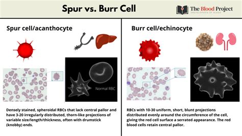 Spur Cells Vs Burr Cells