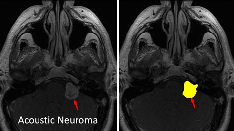 Acoustic Neuroma — Matthew Mian, MD