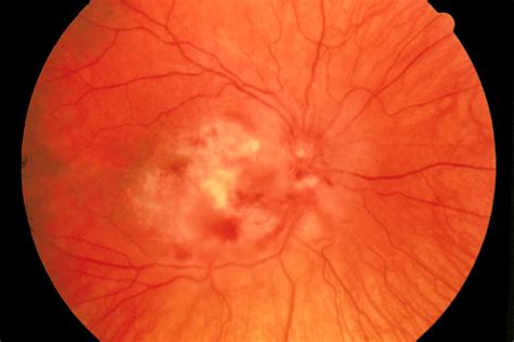 File:Fundus photograph-CMV retinitis EDA07.JPG - Wikimedia Commons