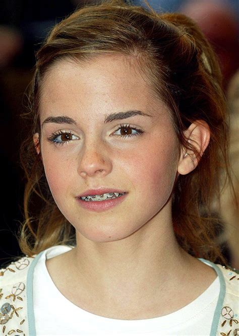 Emma Watson. | Celebrities with braces, Emma watson, Emma watson hair