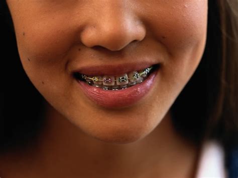 Need braces? Say goodbye to 'metal-mouth' taunts