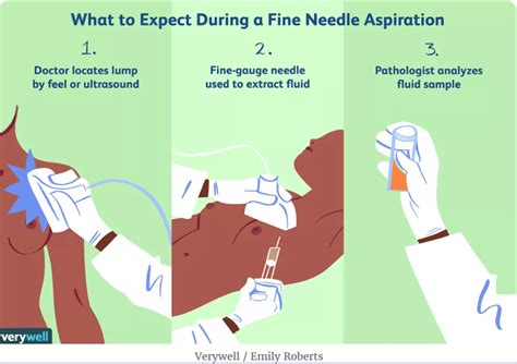 Fine needle aspiration procedure [18] | Download Scientific Diagram