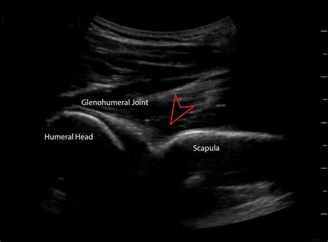 The Suprascapular Nerve Block - Sports Medicine Review