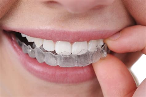 How Much Do Braces Cost in the UK? - The Dental Guide