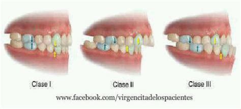 class occlusion dental – dental occlusion classification chart – QFB66