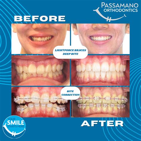 Custom Braces with Deep Bite FAST BRACES - Passamano Orthodontics