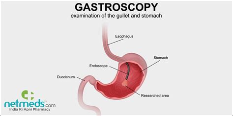 Gastroscopy: Procedure, Risks And Results | Netmeds