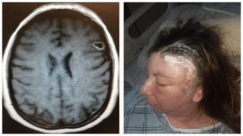 Symptoms Of Brain Tumor In Female - BRAINLYXA