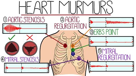 Learn Heart Murmurs In 10 Minutes (With Heart Murmur Sounds) - YouTube