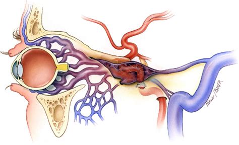 Carotico-cavernous fistuala and Dural AV malformation | Varicose veins ...