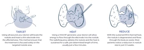 Thyroid Radiofrequency Ablation (RFA) | amcrclinic.com