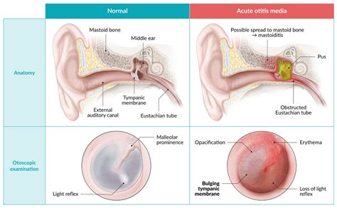 Tympanosclerosis: Causes, Symptoms Treatment, 56% OFF