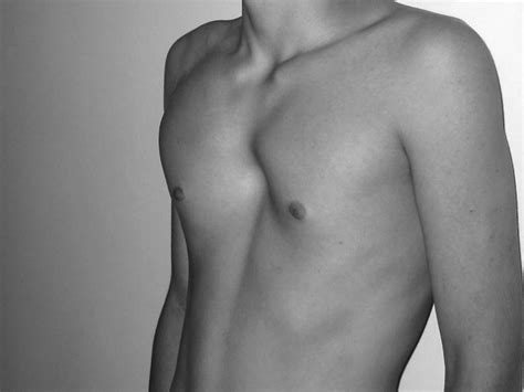 Chest Deformity Pectus Carinatum | Images and Photos finder