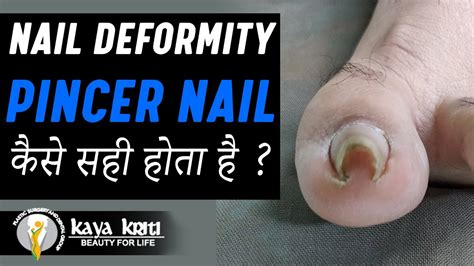 Perfectly Pinned: Surgical Correction of Pincer Nail Deformity ...