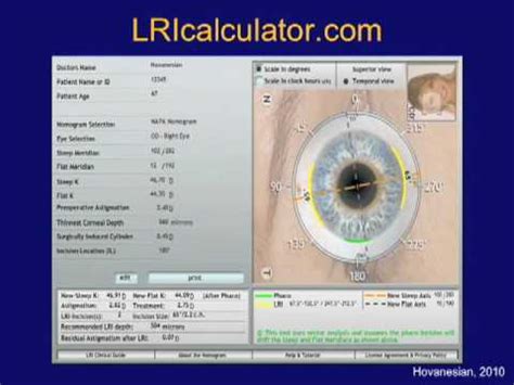 Astigmatism Correction - Cataract Surgery - Part 1 - YouTube