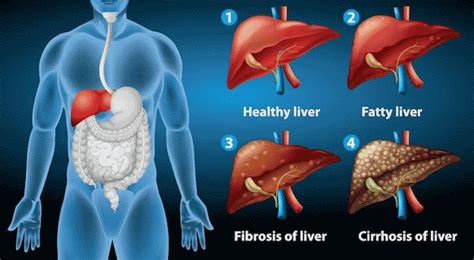 Liver Cirrhosis Causes Symptoms Diagnosis Treatment Medicine My | The ...