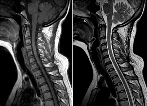 Rare Cause of Nuchal Pain: Calcification of the Alar Ligament | The Journal of Rheumatology