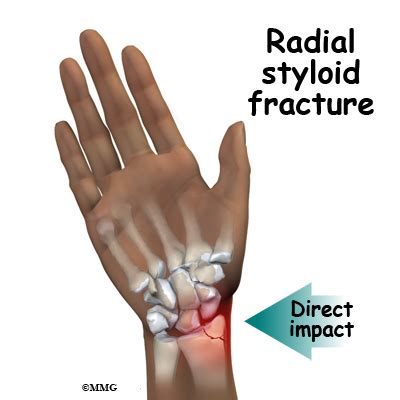 Distal Radius Anatomy - Anatomy Reading Source