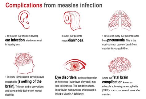 Measles