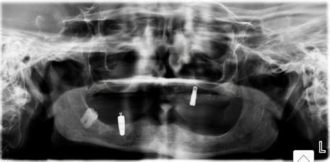 Coronectomy and Implant Burial - THE TRUE LIFE OF A DENTAL STUDENT ...