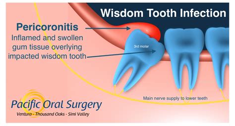 Can Wisdom Teeth Cause Ear Pain – Boston Dentist – Congress Dental Group 160 Federal St Floor 1 ...
