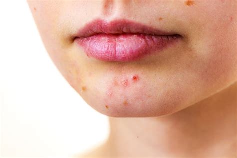 5 Surprising Causes of Adult Acne and What You Can Do About It: Orange Coast Dermatology ...