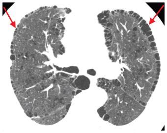 Decreased Lung Attenuation: Emphysema, Mosaic Perfusion, and Cystic Lung Disease | Radiology Key