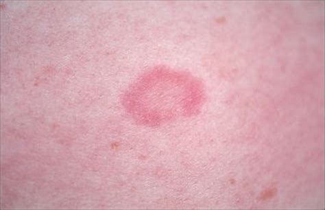 Annular Circular Skin Rash Cancer