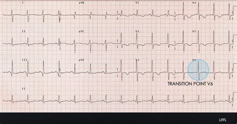 The ECG’s of Pulmonary Embolism | Resus