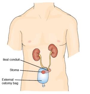 Bladder Removal Surgery: What is a Cystectomy? | BCAN