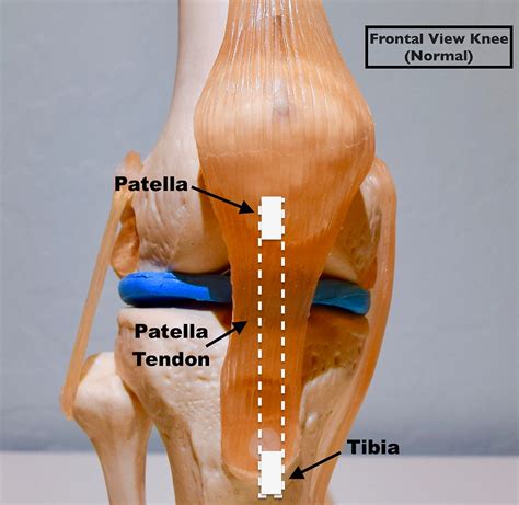 Essentials of Choosing an ACL Graft