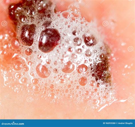 Wound on Human Skin in Hydrogen Peroxide Stock Photo - Image of ...