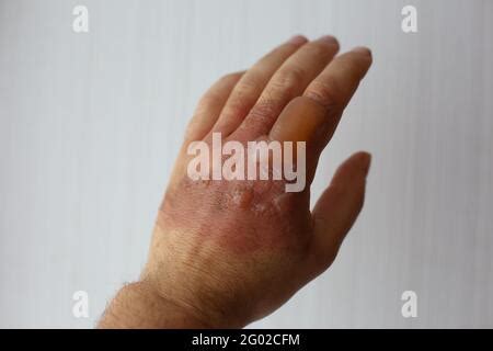 severe burn and blister on the hand, the palm burned with boiling water ...