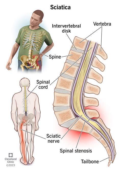Sciatica: What It Is, Causes, Symptoms, Treatment & Pain Relief