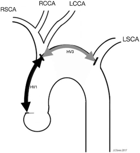 Illustration of a bovine aortic arch branching pattern and distances... | Download Scientific ...