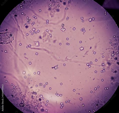 Calcium Oxalate Kidney Stones Microscope