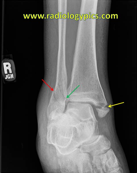 Avulsion Fracture Ankle Lateral Malleolus / Find all the fractures | Ridemonkey Forums ...