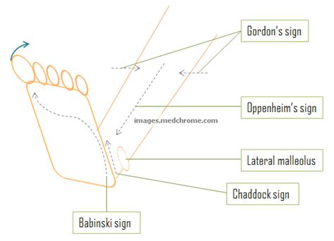 Pathological reflexes - Variations of Babinski | Epomedicine