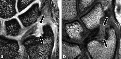 Left Wrist Tfcc Tear Mri Images - bmp-nation