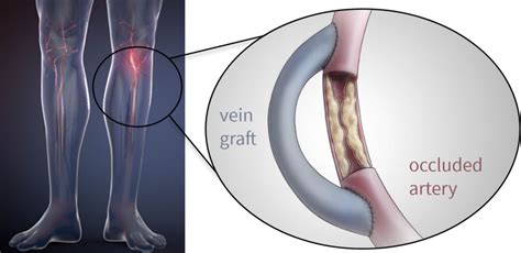 Surgical Bypass – North Texas Vascular Center