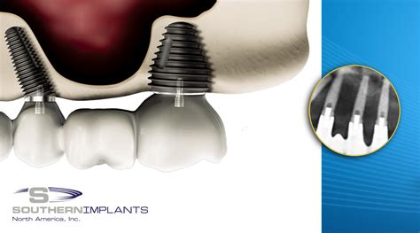 Predictable Anterior Aesthetics with Dental Implants | Southern Implants