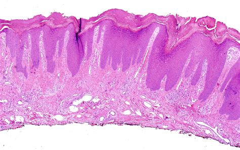 Lichen Simplex Chronicus Histology