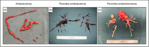 Three types of surgery can be performed for pulmonary emboli. (a ...