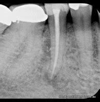 Bondi Junction Dental » Variations in Root Canals