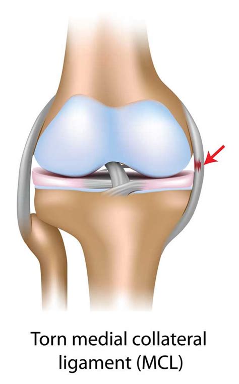 MCL Injury |Medial Collateral Ligament | Orthopedic Knee Specialist ...