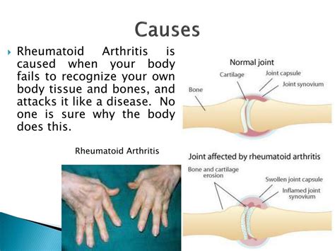 PPT - Rheumatoid Arthritis PowerPoint Presentation, free download - ID:2015756